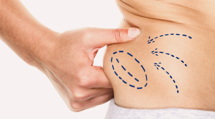 The Truth About Liposuction: Is It Really the Shortcut to Your Dream Body?